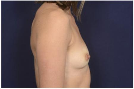 Before image 3 Case #102346 - Breast Augmentation