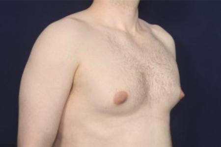 Before image 2 Case #102501 - Gynecomastia