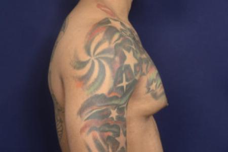 Before image 3 Case #102466 - Gynecomastia
