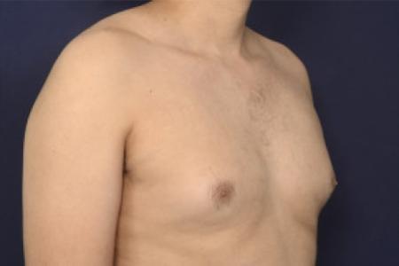 Before image 2 Case #102366 - Gynecomastia