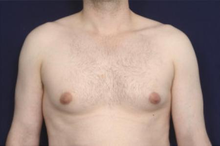Before image 1 Case #102501 - Gynecomastia