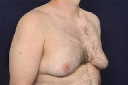 Before image 2 Case #102426 - Gynecomastia