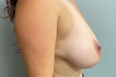 Before image 3 Case #103241 - Breast Reduction for a 36 year old Female
