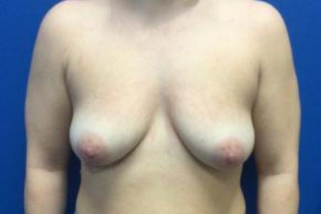 Before image 1 Case #103331 - Silicone Breast Augmentation & Mastopexy for a 29 year old female
