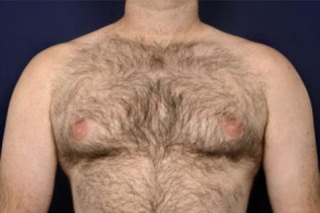 Before image 1 Case #102481 - Gynecomastia