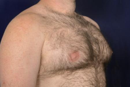 Before image 2 Case #102481 - Gynecomastia