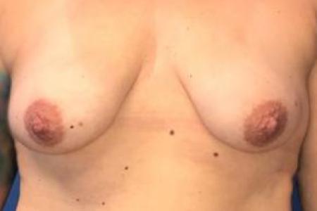 Before image 1 Case #103276 - Silicone Breast Augmentation for a 38 year old female