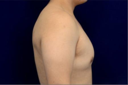 Before image 3 Case #102731 - Gynecomastia