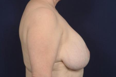 Before image 3 Case #102586 - Auto-Augmentation Mastopexy