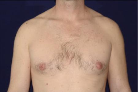 Before image 1 Case #102646 - Gynecomastia