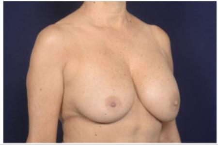 Before image 2 Case #103061 - Breast Augmentation Revision