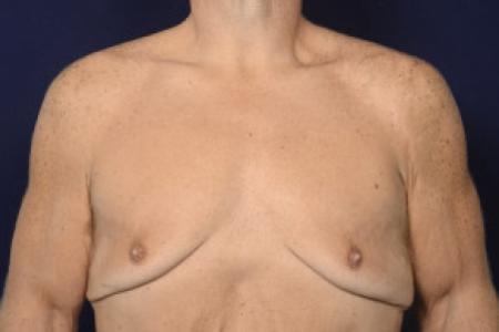 Before image 1 Case #102431 - Gynecomastia
