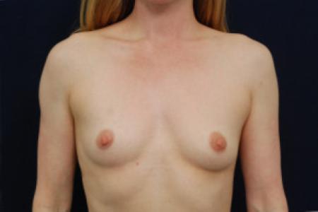 Before image 1 Case #102666 - Breast Augmentation
