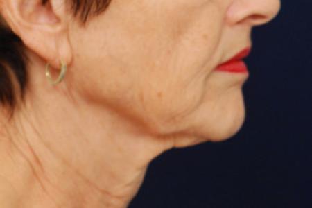 Before image 3 Case #102781 - Lower Facial Rejuvenation