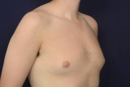 Before image 2 Case #102491 - Gynecomastia