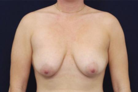 Before image 1 Case #102721 - Augmentation Mastopexy