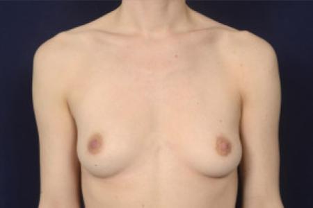 Before image 1 Case #102451 - Breast Augmentation
