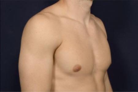 Before image 2 Case #102751 - Gynecomastia