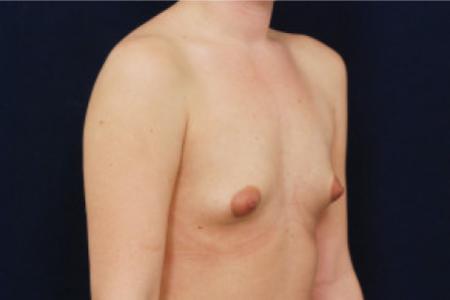 Before image 2 Case #102711 - Breast Augmentation