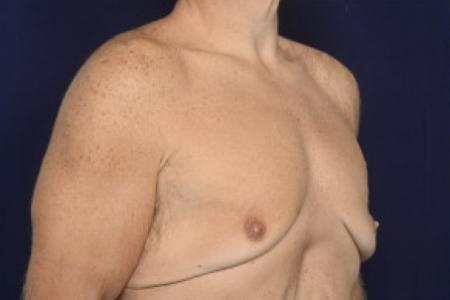 Before image 2 Case #102431 - Gynecomastia