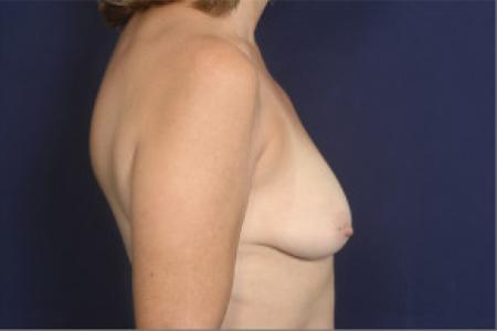 Before image 3 Case #102421 - Breast Augmentation