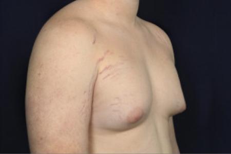 Before image 2 Case #102376 - Gynecomastia