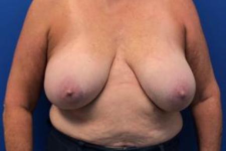 Before image 1 Case #103296 - Breast Implant Explantation with a wise pattern Breast Reduction for a 57 year old female