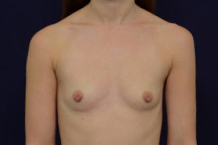 Before image 1 Case #102706 - Breast Augmentation
