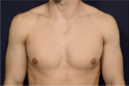 Before image 1 Case #102751 - Gynecomastia