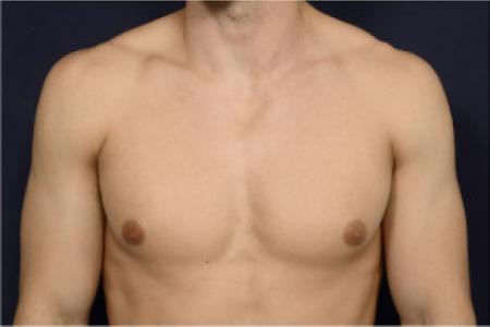 Before image 1 Case #102751 - Gynecomastia