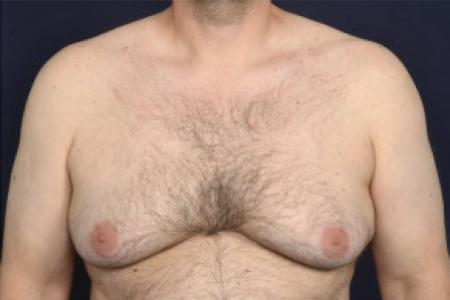 Before image 1 Case #102426 - Gynecomastia