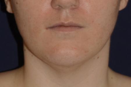 Before image 1 Case #102801 - Neck Lift