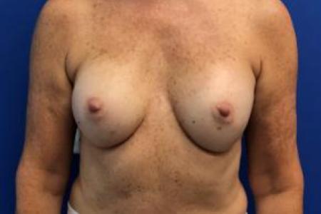 Before image 1 Case #103256 - Silicone Gel Implants for a 53 year old female.