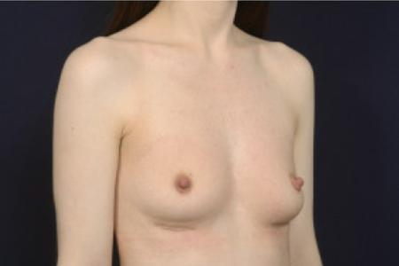 Before image 2 Case #103066 - Breast Augmentation Revision