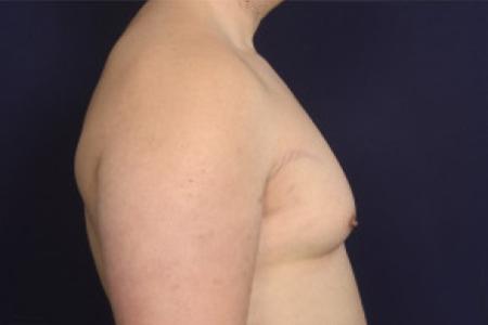 Before image 3 Case #102526 - Gynecomastia