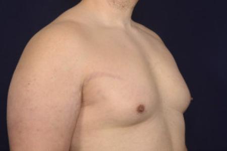 Before image 2 Case #102526 - Gynecomastia