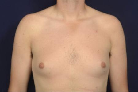 Before image 1 Case #102491 - Gynecomastia