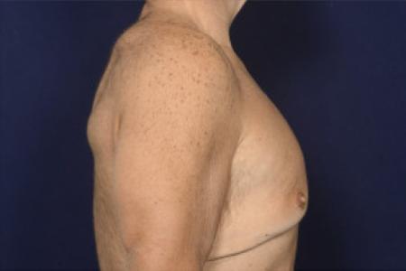 Before image 3 Case #102431 - Gynecomastia