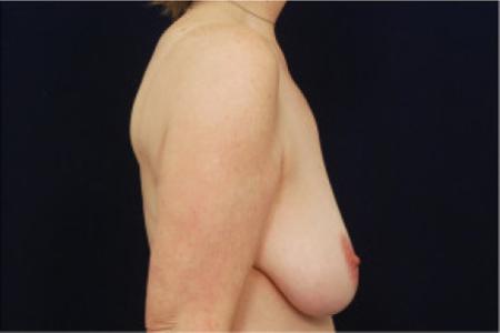 Before image 3 Case #102996 - Mastopexy