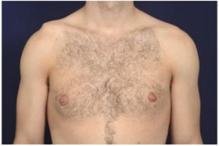 Before image 1 Case #102356 - Gynecomastia