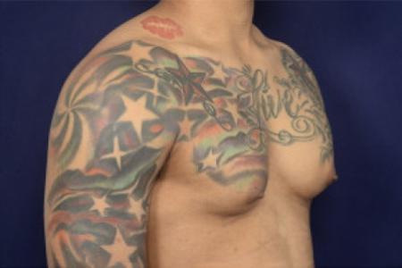 Before image 2 Case #102466 - Gynecomastia