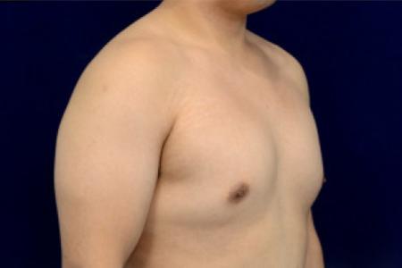 Before image 2 Case #102731 - Gynecomastia