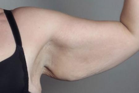 Before image 2 Case #103136 - Upper Arm Lift 15