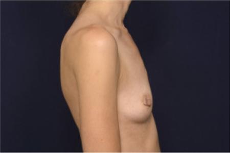 Before image 3 Case #102746 - Breast Augmentation