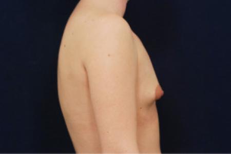 Before image 3 Case #102711 - Breast Augmentation