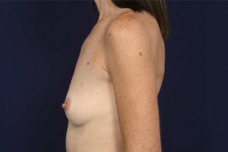 Before image 3 Case #103101 - Fat Grafting of Breasts