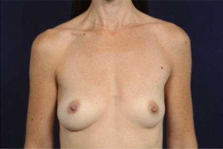 Before image 1 Case #103101 - Fat Grafting of Breasts