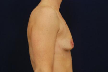 Before image 3 Case #103016 - Augmentation Mastopexy