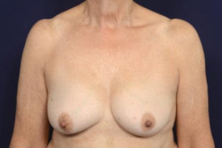 Before image 1 Case #103106 - Fat Grafting of Breasts