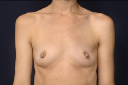 Before image 1 Case #102746 - Breast Augmentation